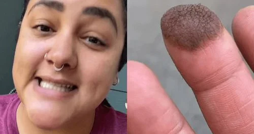 Dəri transplantasiyası olan qızın barmağından tüklər çıxdı