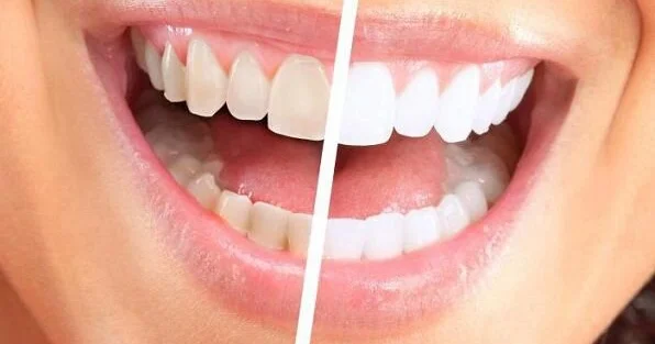 Dişinizin rəngi qəfil dəyişib? Səbəbi budur