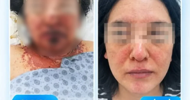 Dərman qəbulundan sonra ağır allergik reaksiya verdi Foto