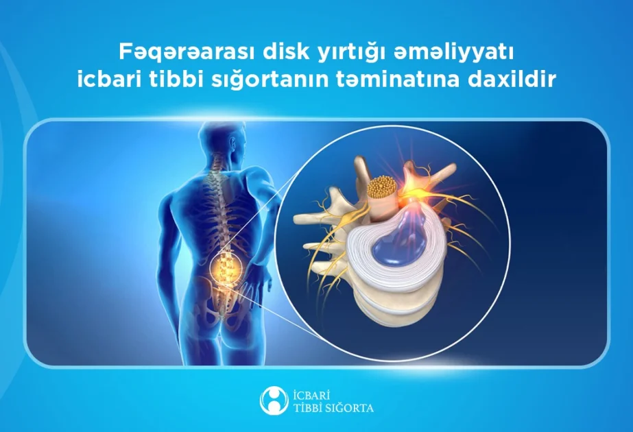 Fəqərəarası disk yırtığı əməliyyatı icbari tibbi