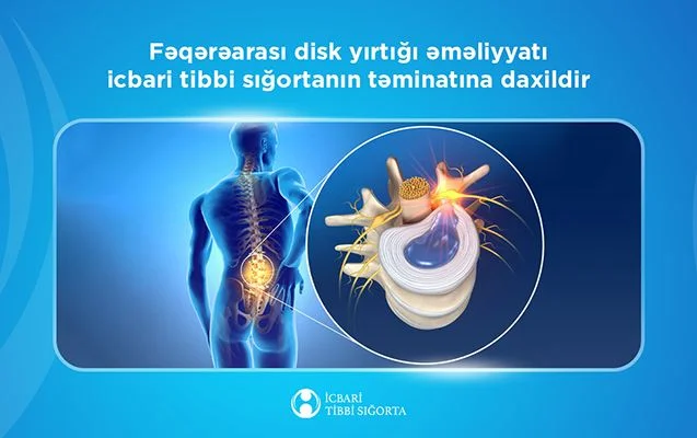 Bu əməliyyat da icbari tibbi sığortanın təminatına daxildi