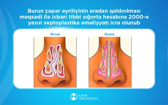 İcbari tibbi sığorta ilə 2000ə yaxın burun çəpəri əməliyyatı icra olundu