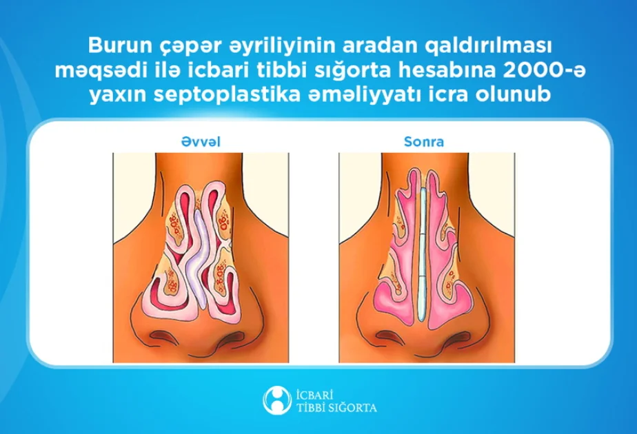 2 minədək burun çəpəri əməliyyatı yerinə yetirilib