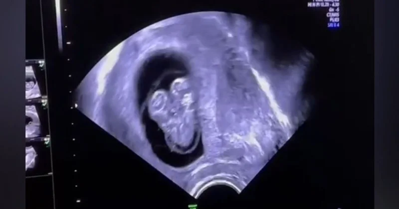 Azərbaycanda hamilədə Siam əkizləri görüldü Video