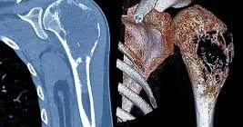 Xərçəngin sümüklərə yayılmasının əlamətləri