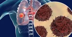 Kişilərdə ağciyər xərçəngi birinci yerdədir, səbəbi... Onkoloq Vüsalə Tağıyeva