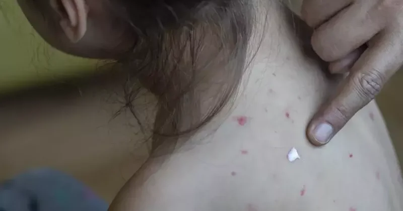 Казахстанские врачи бьют тревогу каждый день в стране выявляют до 25 заболевших корью