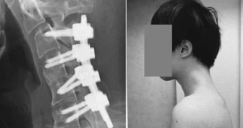 Uzun müddət telefona baxan kişinin başı əyildi Nadir sindrom