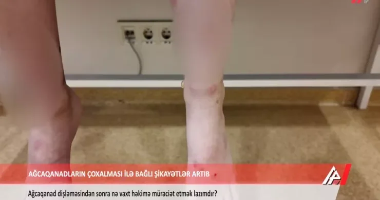 Builki ağcaqanadlar Bakı sakinlərini xəstəxanalıq etdi VİDEO