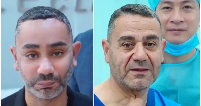 58 yaşlı kişi gəncləşmək üçün Viyetnama getdi, tanınmaz hala düşdü