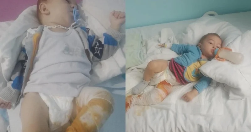 Bədəni yanan ikiyaşlı Tunarın dəstəyə ehtiyacı var
