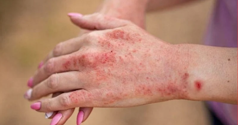 Dermatloq: Sızanaq xərçəng əlaməti ola bilər