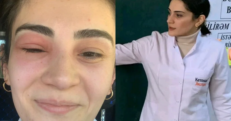Gözünü arı sancan kimya müəllimi: “Tək gözlə 55 bal topladım”
