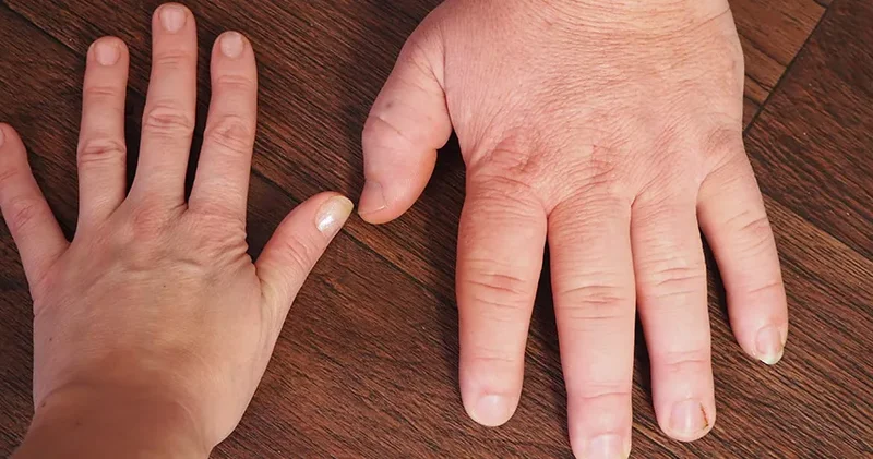 Akromeqaliya: Böyümə hormonu artıqlığının əlamətləri, diaqnozu və müalicəsi