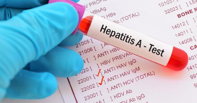 Azərbaycanda virus hepatiti ilə bağlı son statistika açıqlandı