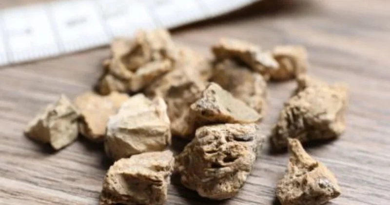 Kanadalı alimlərdən böyrək daşlarına qarşı YENİ ÇARƏ