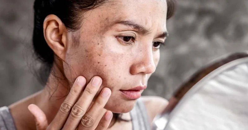 Dermatoloqdan xəbərdarlıq: Günəş yanığına qarşı bu addımları atın