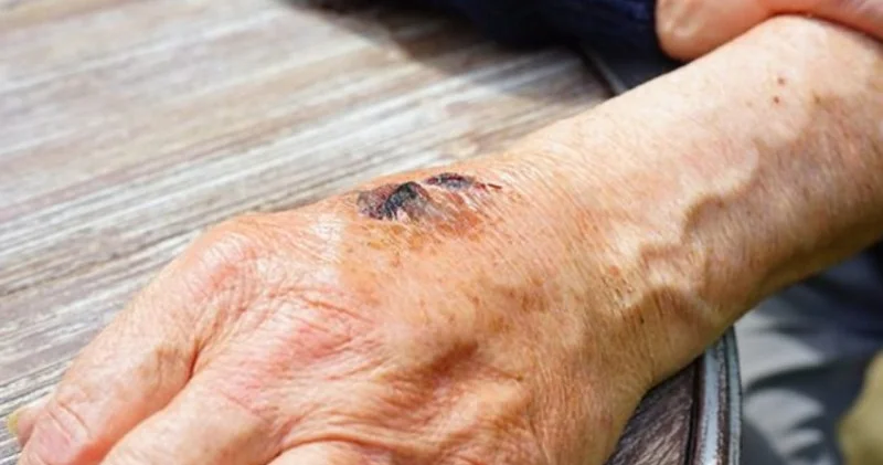 Ötən il Azərbaycanda qarayaraya yoluxanların sayı artıb