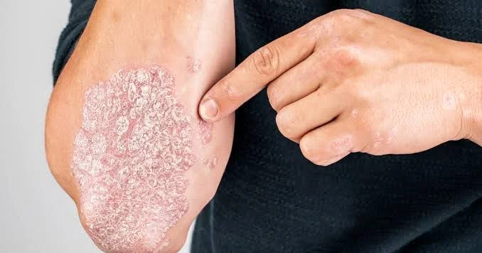 Psoriaz niyə təkrarlanır? Mütəxəssis səbəbləri açıqladı VİDEO