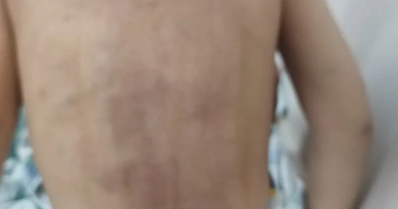 Lənkəranda atalığı 3 yaşlı uşağı döyüb? Foto Yenilənib