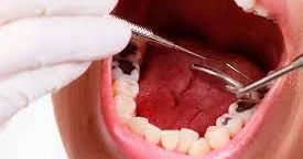 Çürük dişlər qida borusu xərçənginə səbəb ola bilər