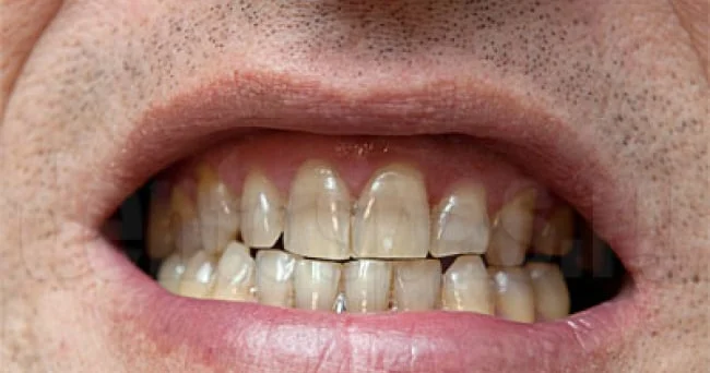 Diş minasını ən çox ləkələyən qəhvə növü hansıdır?