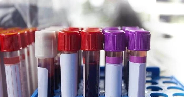 Bu ucuz analizi hamı versin, xərçəng riskini göstərir Kardioloqdan