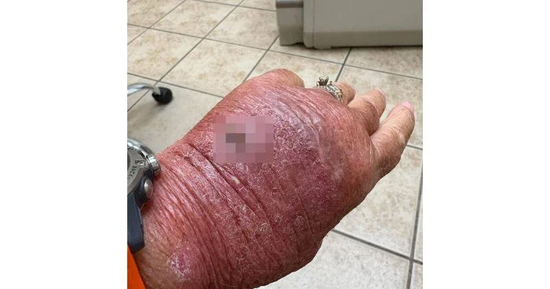 Женщина едва не лишилась руки, случайно порезав ее картоном