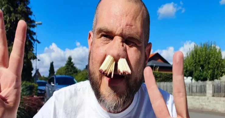 Kişi burnuna rekord sayda kibrit çöpü yığdı