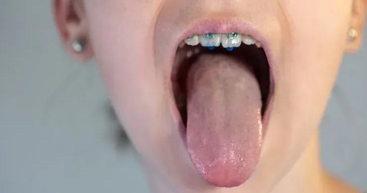 Səhərlər dilin üzərində niyə ağ örtük yaranır?