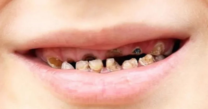 Uşaqlarda erkən diş çürüməsi səbəbləri