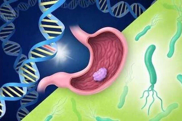 Найден новый способ диагностики и лечения рака желудка