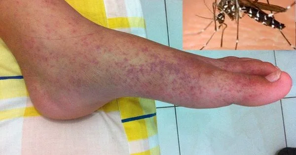 20 ilin ən güclü epidemiyası Çikunqunya qızdırması