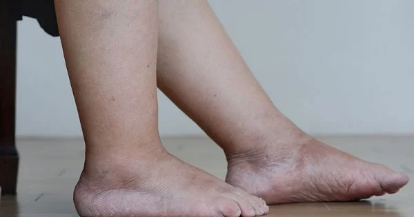 Bədəndə şişkinlik bu 3 səbəbdən ola bilər Kardioloq xəbərdarlıq edir
