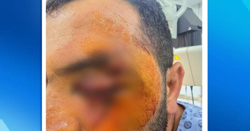 Elektrik mişarla üzü gözü doğranan kişi əməliyyat olundu