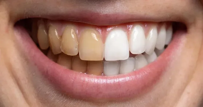 Dişlərdə sarı ləkələr çox vaxt çay istifadəsindən sonra yaranır