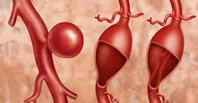 Hansı vitaminin əskikliyi damarları nazildir?