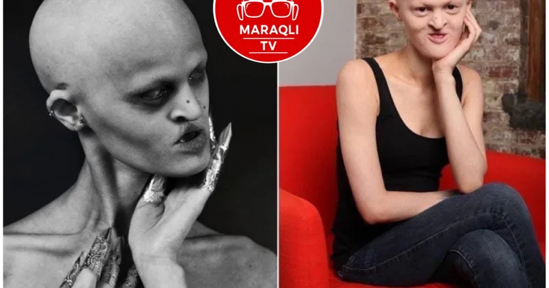 Dünyada nadir rast gəlinir: “Vampir xəstəliyi” nədir?