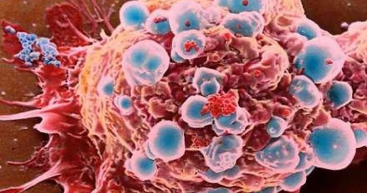 Xərçəngə qarşı yeni yanaşma: Hər kəs 6 aydan bir bunu etməlidir