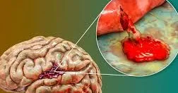 İnsultdan 1 həftə əvvəl hansı işarələr olur?