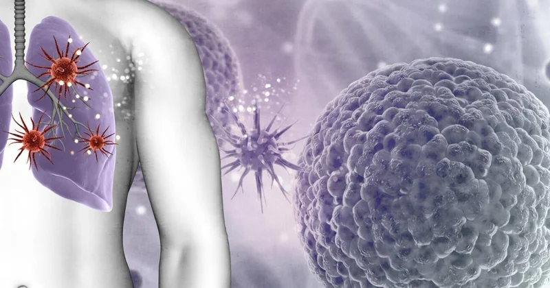 Azı gündə 3 dəfə yeyirik Ağciyər xərçəngi yaradır