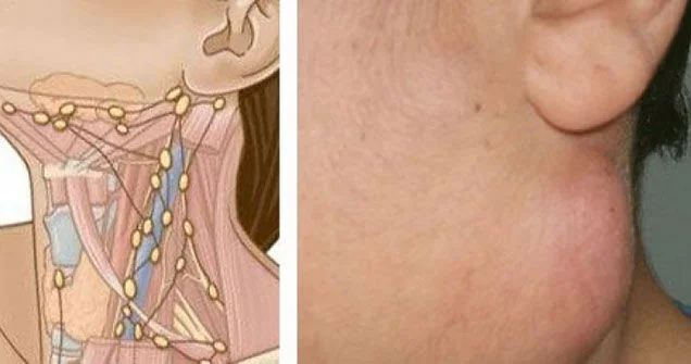 Boyunda şişmiş limfa düyünləri Müalicəsi