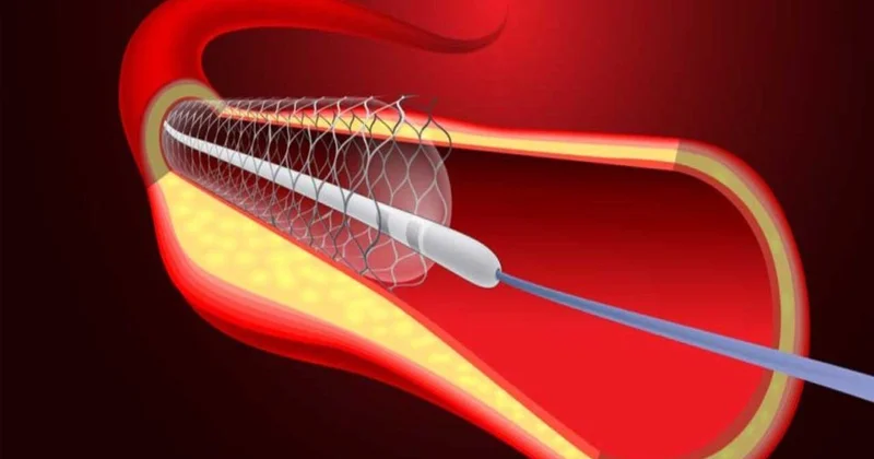Stendlərin ömrü nə qədərdir? Kardioloqdan cavab
