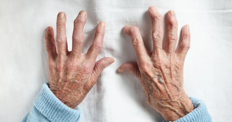Revmatoid artritin ən erkən 7 ƏLAMƏTİ