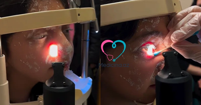 Şagirdin istifadə etdiyi ağardıcı partladı Gözü zədələndi VİDEO