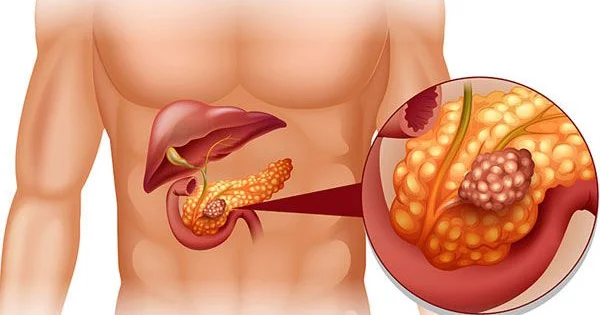 Kəskin pankreatitdə yüksəkdozalı vitamin C sağalmanmı sürətləndirir