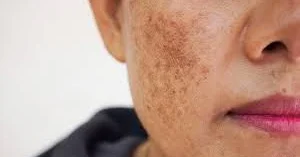 Kseroderma Günəş təhlükəli və ölümcül olur