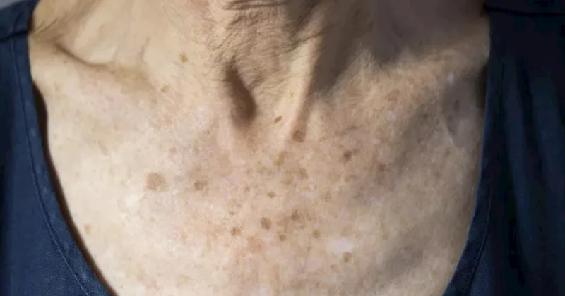 Günəş ləkəsidir, yoxsa dəri xərçəngi? Bu əlamətlər varsa, dərhal dermatoloqa qaçın