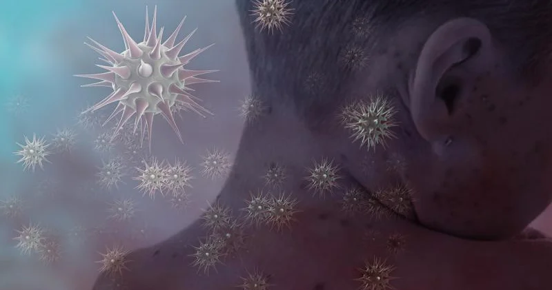 İndoneziyada qızılca epidemiyası: 17 nəfər ölüb