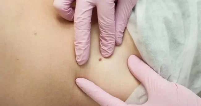 Virus da xərçəng yaradırmış